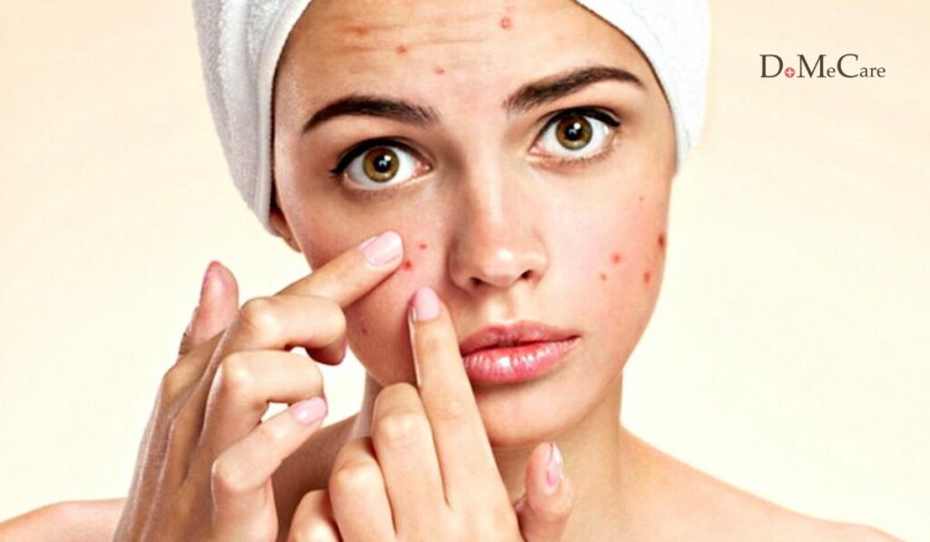 Dùng Niacinamide bị lên mụn