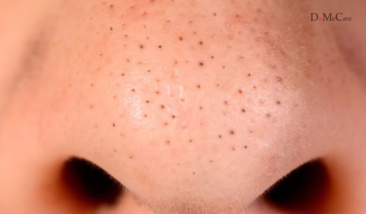 Trị mụn đầu đen tại nhà