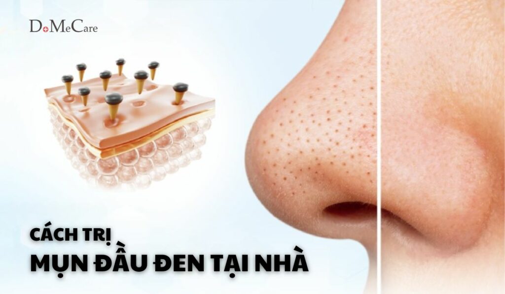 Trị mụn đầu đen tại nhà