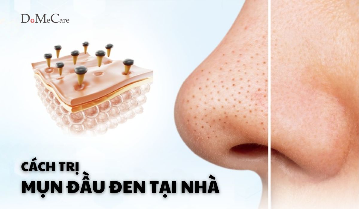 Trị mụn đầu đen tại nhà