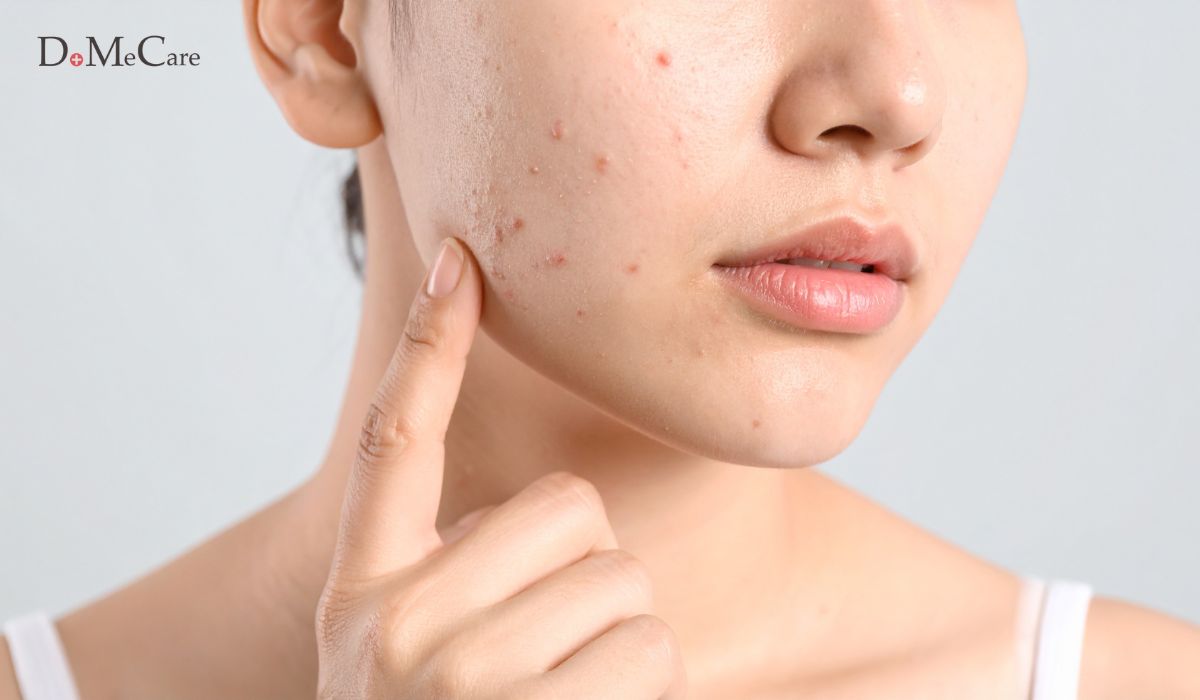 Lua chon mat na cho da dau mun