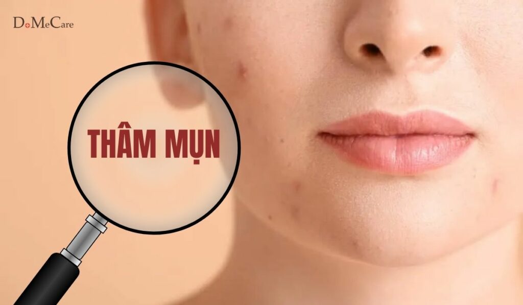 Thâm mụn