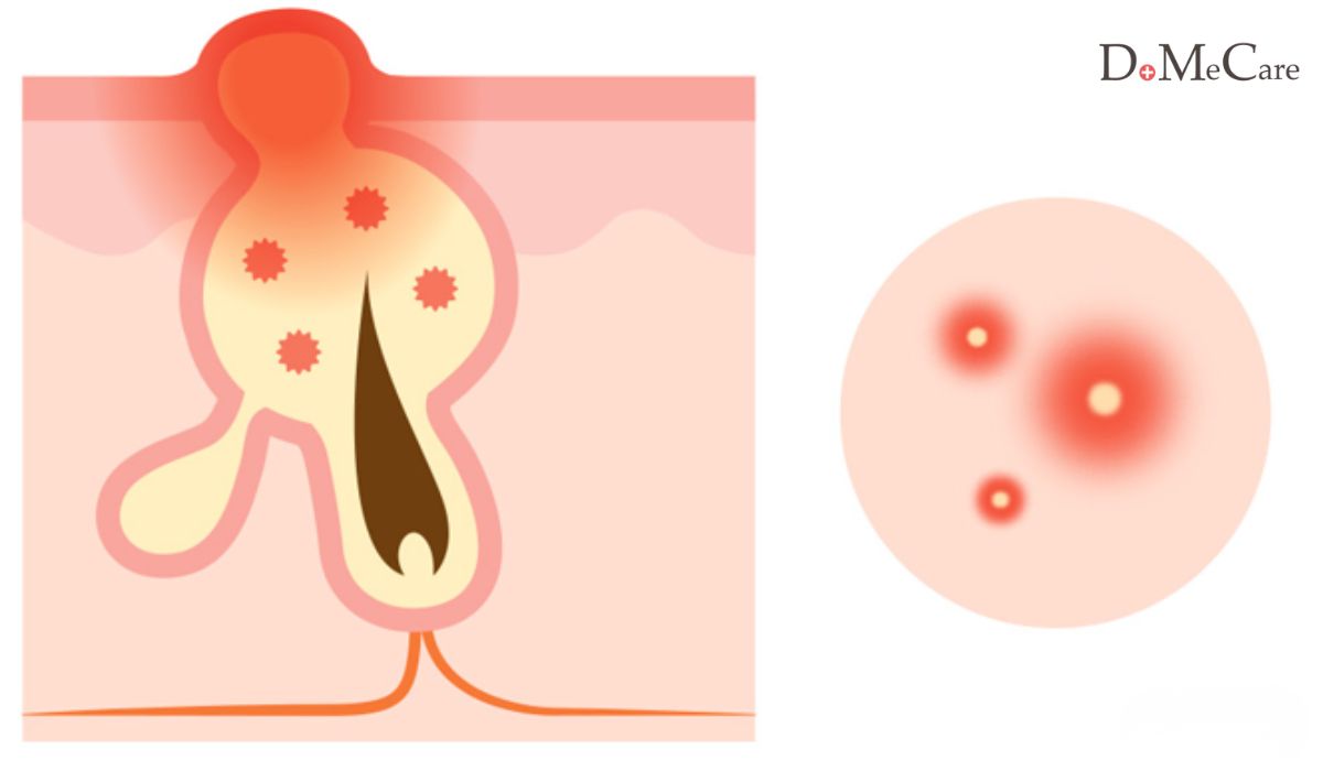 Vòng đời của mụn
